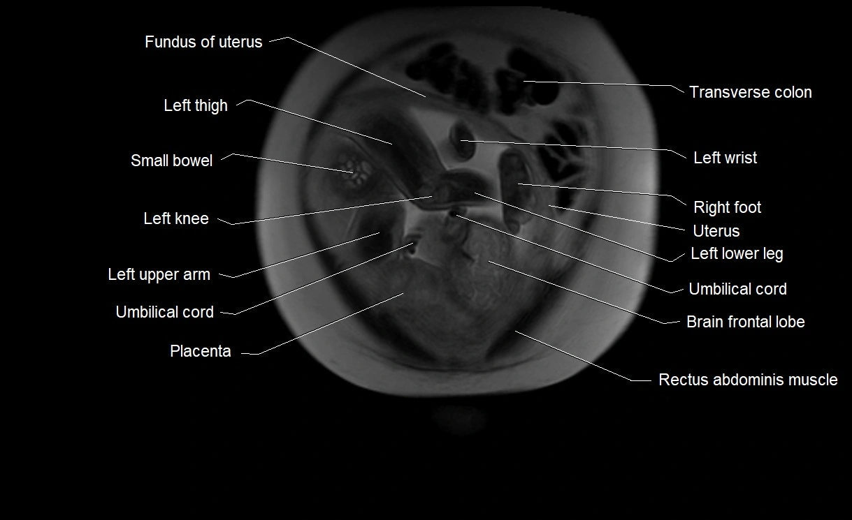 MRI Anatomy of pregnancy image 6.webp